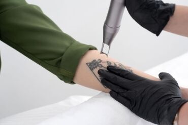 Remoção de Tatuagem com Laser em São Paulo: Tratamento, Resultados e Preço Remoção de Tatuagem com Laser em São Paulo: Tratamento, Resultados e Preço